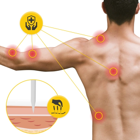 Akupunkturní jehly s trubičkou 100 ks. 0,25 x 30 mm